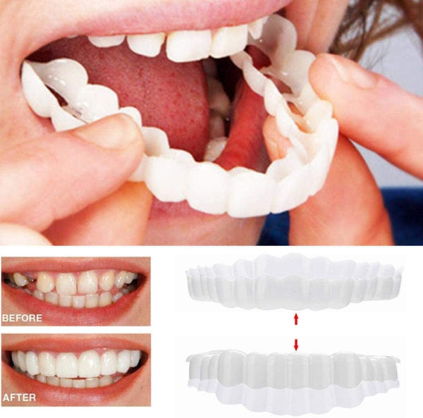 Veneers für ein strahlendes Lächeln - Ober- und Unterkiefer 0