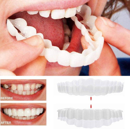 Veneers für ein strahlendes Lächeln - Ober- und Unterkiefer 0