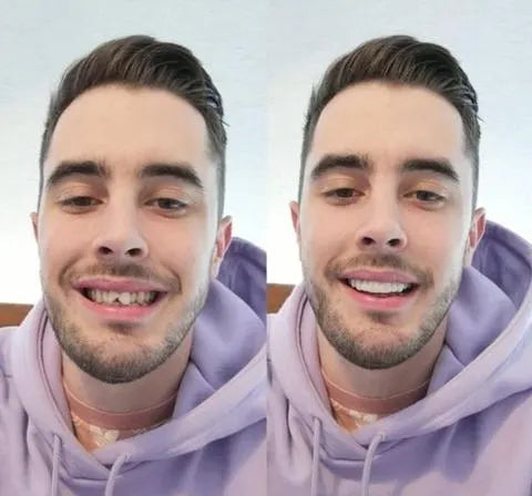 Veneers für ein strahlendes Lächeln - Ober- und Unterkiefer 2